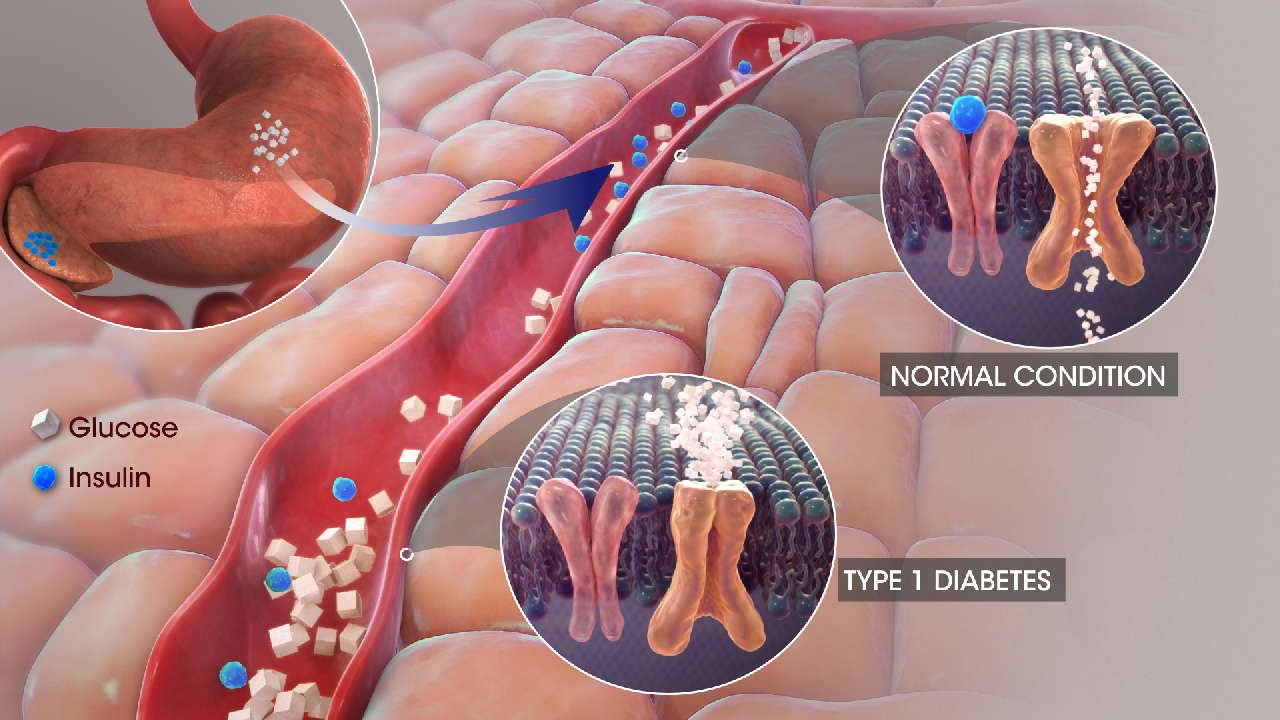 What is Diabetes?